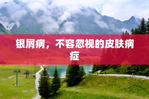银屑病，不容忽视的皮肤病症