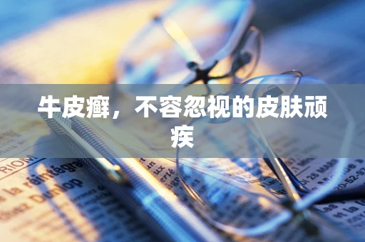 牛皮癣，不容忽视的皮肤顽疾